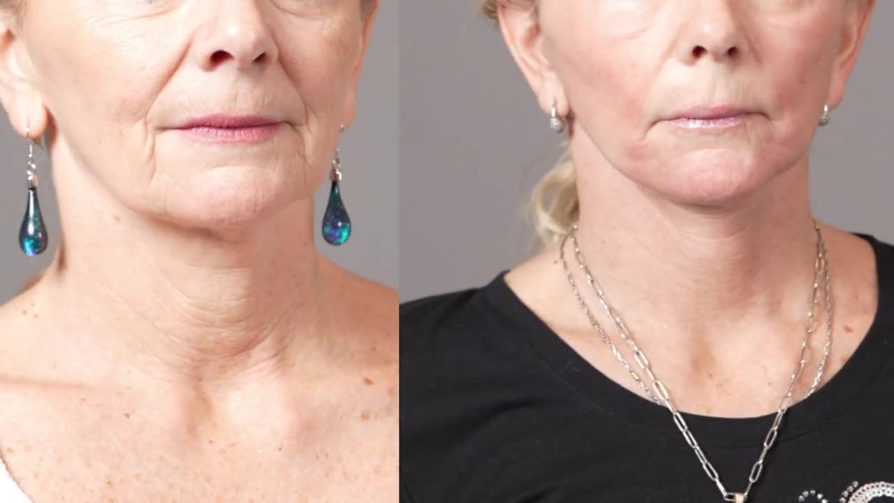 Antes y después de un lifting facial deep plane del Dr. Patané
